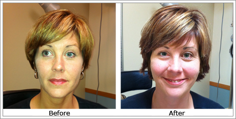 Exotropia & Hypotropia