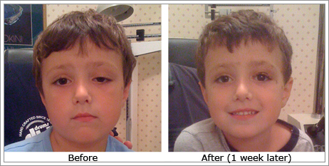 Ptosis (Drooping Eye Lids)