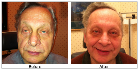 Ptosis (Drooping Eye Lids)