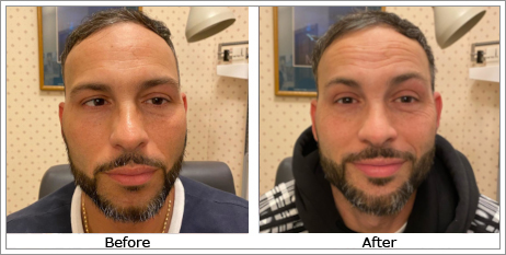 Esotropia (Inturned Eyes)