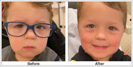 Esotropia (Inturned Eyes)