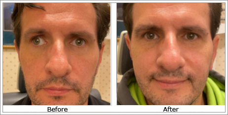 Exophoria (Outturned Eyes)