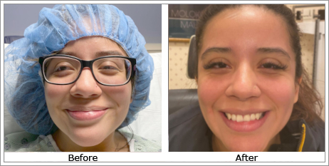 Exotropia (Outward Turning Eyes)opitk