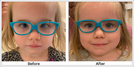 Esotropia (Inturned Eyes)