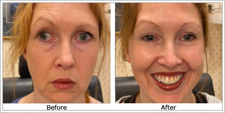 Exophoria (Outturned Eyes)